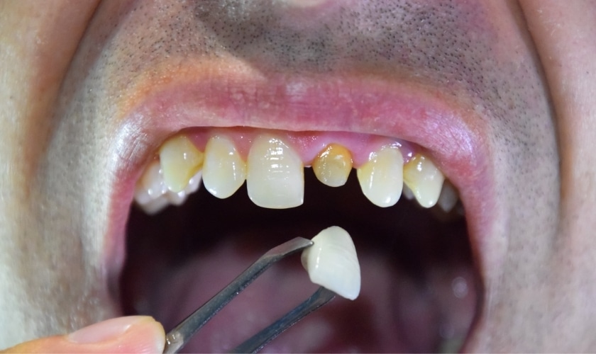 Quick and Effective Solutions for Broken Dental Crowns